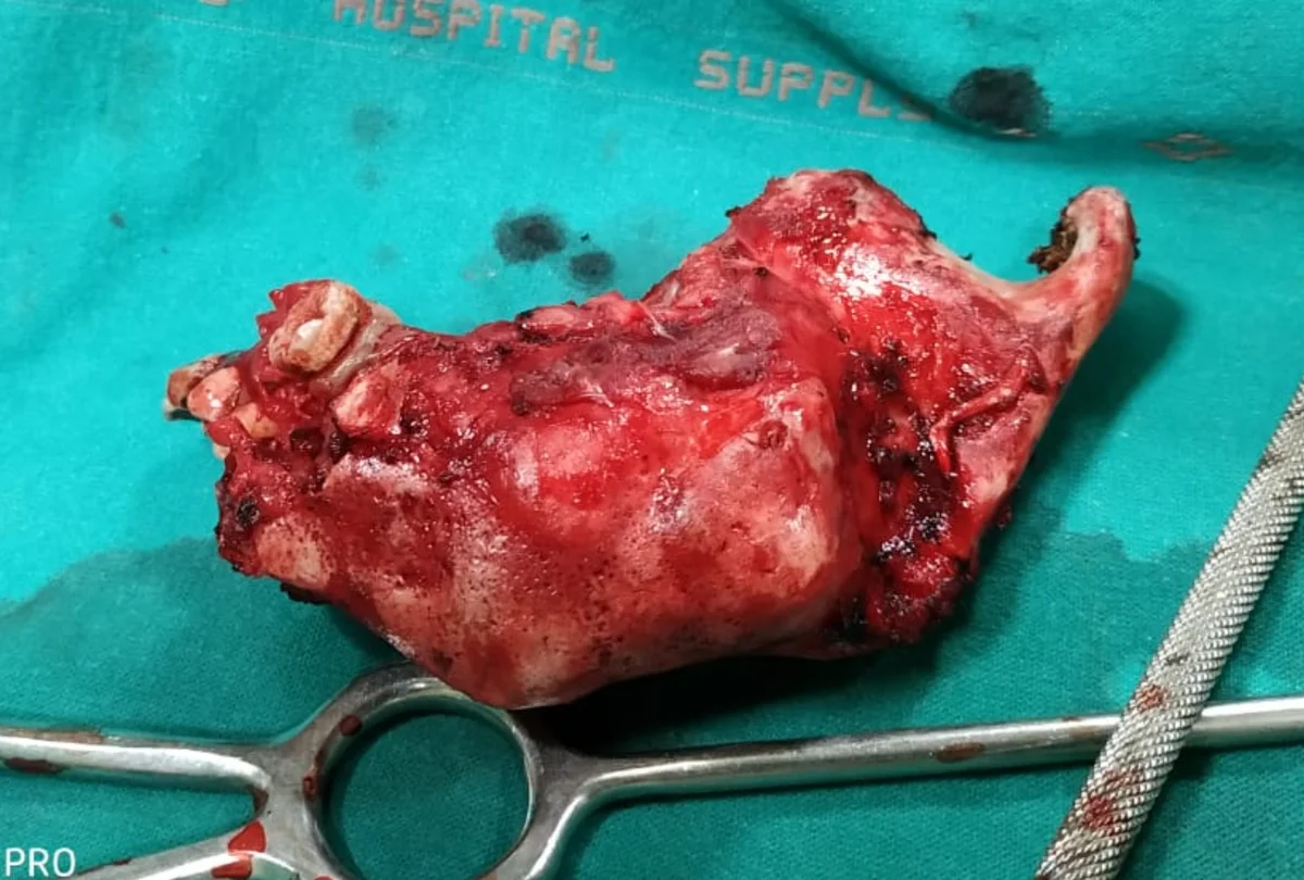 Resected ameloblastoma specimen