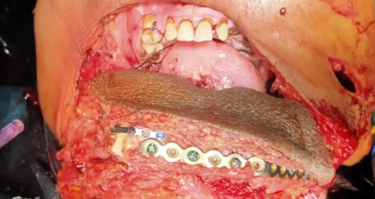 Fibula free flap reconstruction of jaw after tumor resection