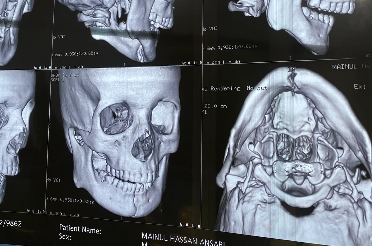 Mandible fracture CT scan