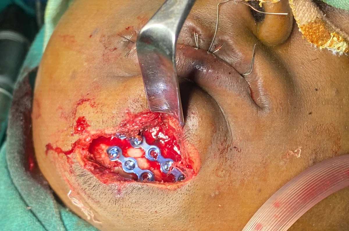 Mandible ORIF titanium plate fixation