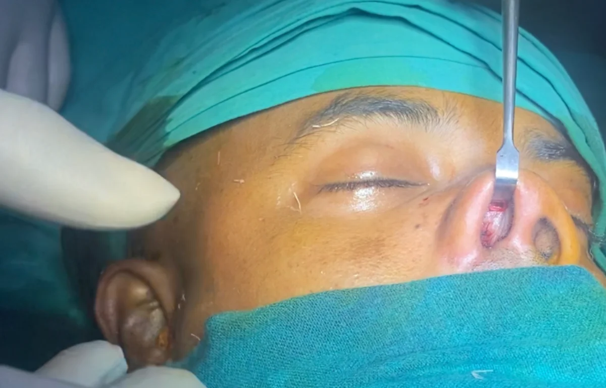 Tunnel technique for nasal augmentation