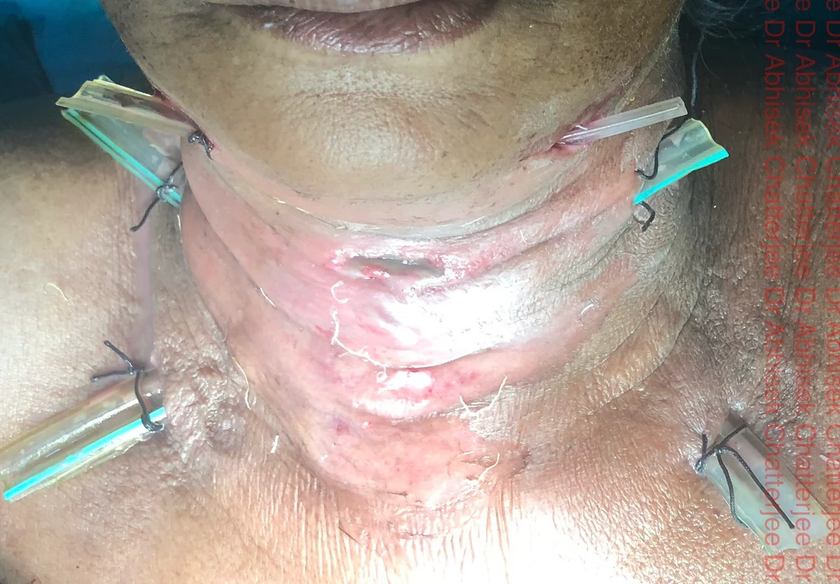 Neck space drainage with drain in situ