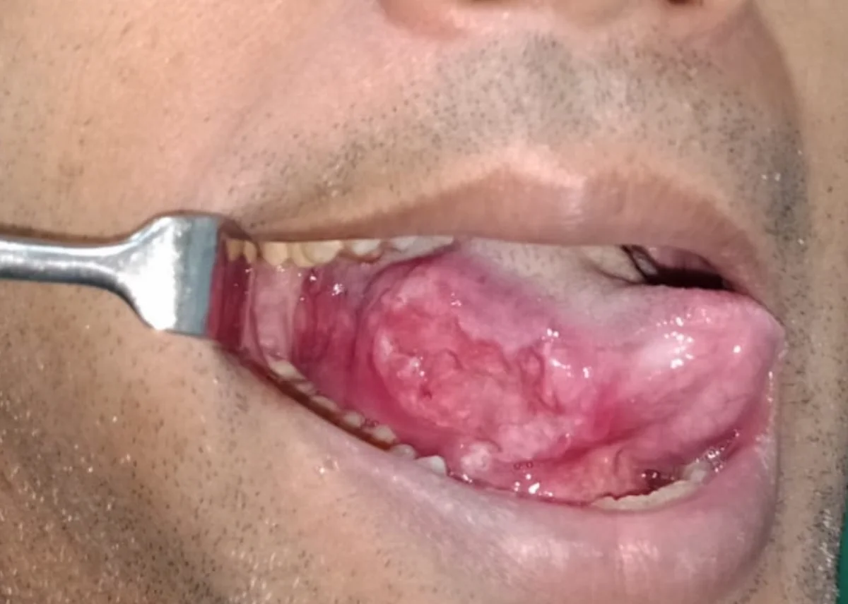 Tongue carcinoma — clinical presentation