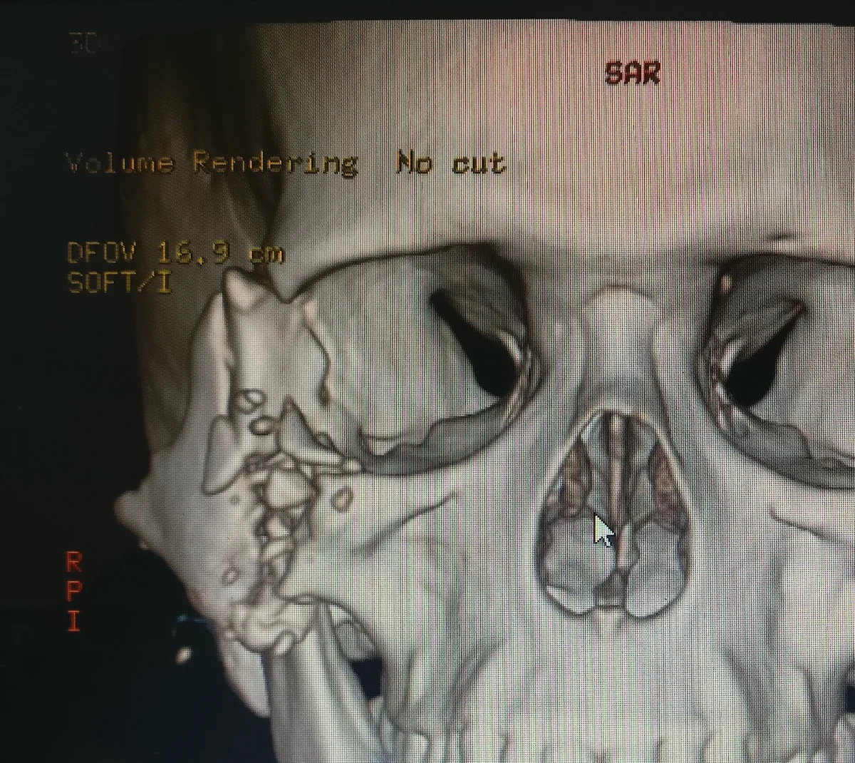 Zygomatic fracture CT scan