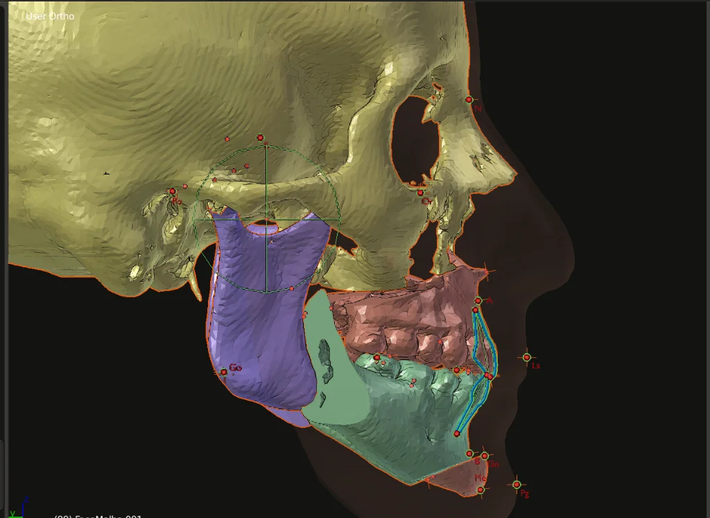 Orthognathic jaw surgery — jaw correction and osteotomy